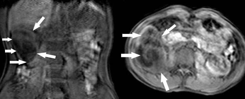 (B)Multiloculated hypoattenuating thin-walled cystic lesion (arrowheads). N=Normal Left Kidney.