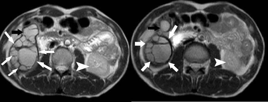 Coronal (B) Axial T1W weighted image obtained on a 1.5 T MRI scanner.