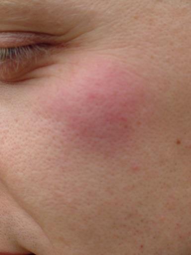 Direct Injuries Insects in eyes,