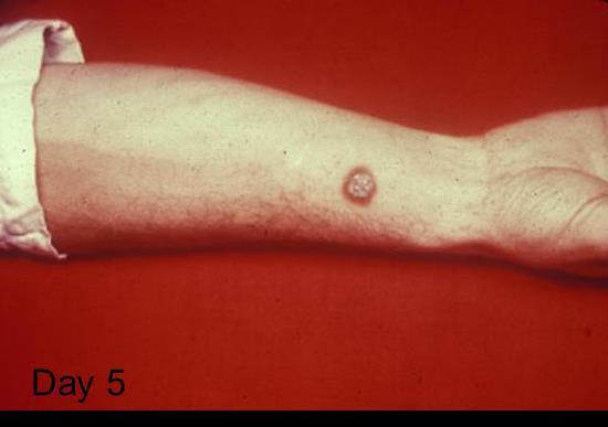 Cutaneous Anthrax Most common form