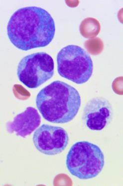 Bone Marrow Aspirate Hypercelllular marrow, predominantly myeloid Left-shifted, but complete maturation