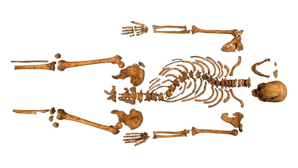 Skelton 1: The skeletal evidence Both arms are normal. There is no evidence for a withered arm. This person suffered from Scoliosis. This caused the spine to curve sideways. They were not hunchbacked.