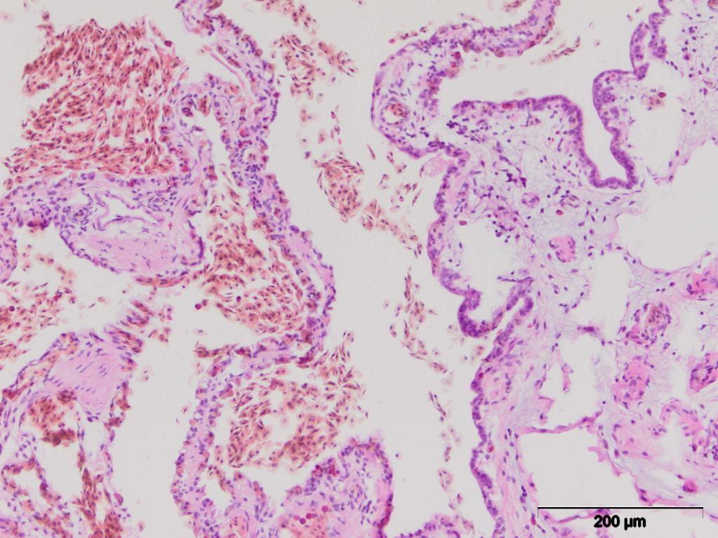Slika 34. Pluća barske kornjče, hemoragija, ekstravazat u intersticijumu, (HE x 200).