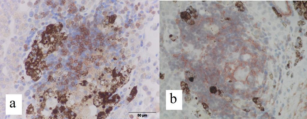 Slika 42 Jetra barske kornjače, a) ekspresija CD3+ T limfocita u granulomu, x 600, b) ekspresija α-sma u