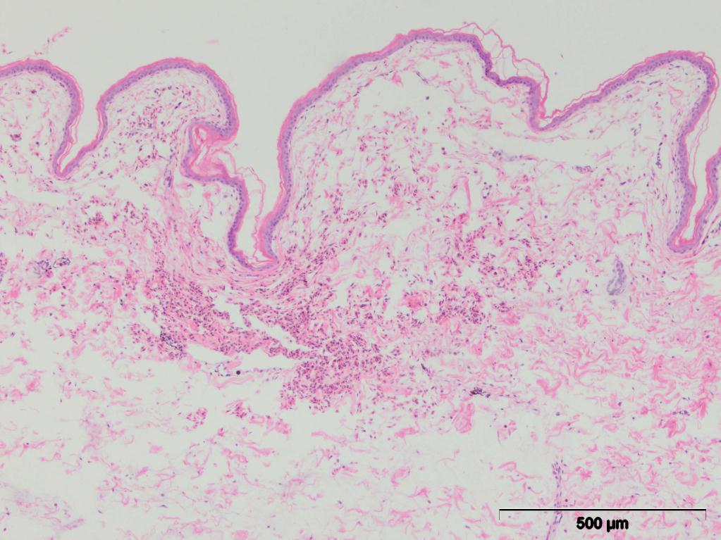 5.5.7. Histopatološke promene u koži Hemoragije u epidermisu su bile dominantan nalaz kod 23/30 (76,6%) ispitanih kornjača (slika 47). Slika 47.