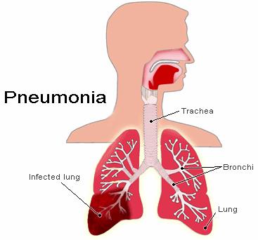 Pneumonia Pneumonia is an inflammation of lungs caused by bacteria, viruses, or chemical irritants Infections are spread from person to person through droplets in