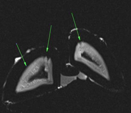MRI Analysis (Lamina Character) Other Considerations Moderately Irregular Inherent structural differences If we see mobility concerns are they a foot/hoof issue How animals are handled during