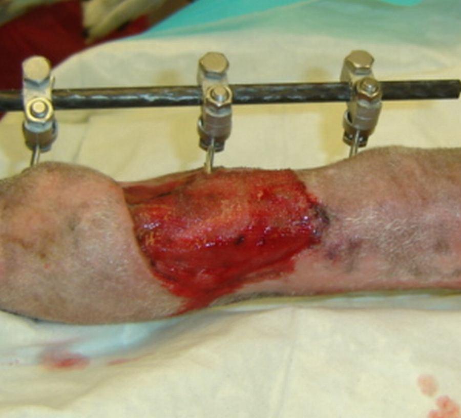 The wounds were managed by debridement and cleansing with chlorine dioxide antiseptic solution daily. The injured right carpal joint was surgically stabilized with transarticular external fixation.