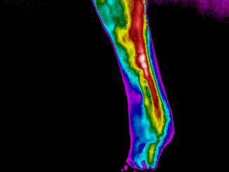 CASE FOUR: SERIAL DOCUMENTATION One of the best uses of thermal imaging is serial imaging of a lesion to monitor healing.
