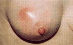 (inflammation breast tissue) 5-10%