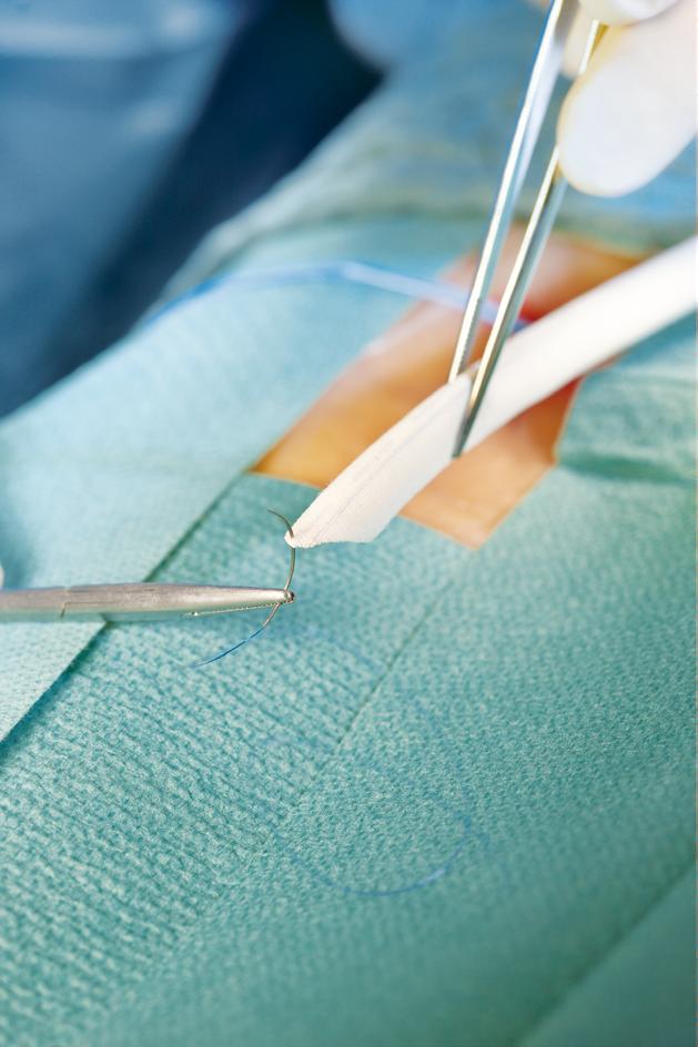 By adding the benefits of eptfe and a knit polyester textile, the FUSION graft sets a new standard for peripheral bypass treatment.