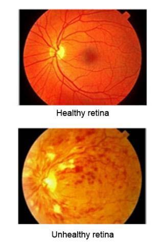 Retinal imaging Retina = Sheet