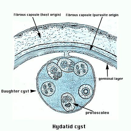 Hydatid Cyst diagram