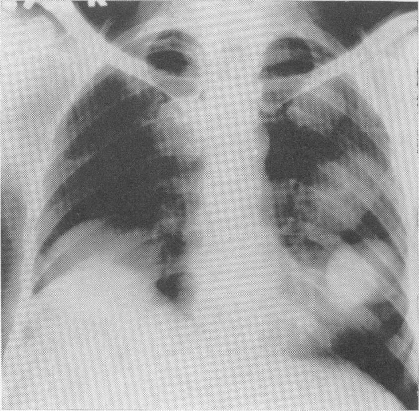 Postgrad. med. J. (December 1967) 43, 774-778. THE LUNG is the second commonest site in man, where the intermediate larval-cysticercal stage of Echinococcus granulosus develops.