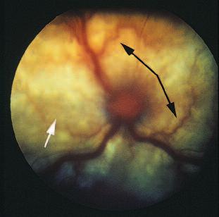 Inflammation also causes ciliary muscle spasm, a major contributor to ocular pain.