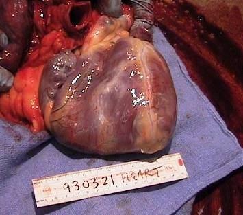 Cardiovascular Disease Heart Failure Fibrosing Cardiomyopathy