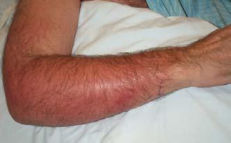 Skin & Soft Tissue Infections (SSTI) Skin & Soft Tissue Infections