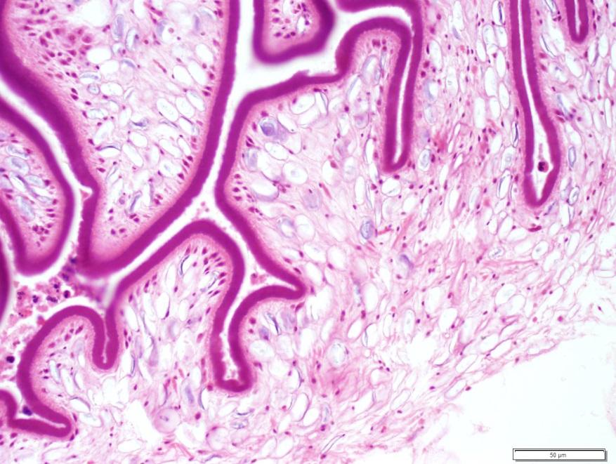 Calcareous corpuscles a histologic features of