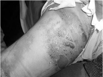Compartment Syndrome Concerns Compartment syndrome is always a concern Clinical signs of Compartment Syndrome: Pain out proportion of injury Pain with passive motion of muscles in the involved