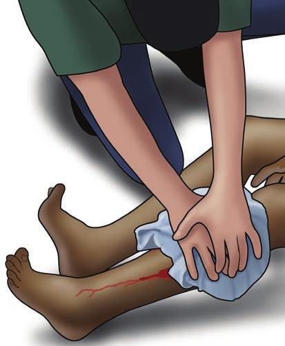 Apply continuous pressure with both hands directly on top of the bleeding wound 4.
