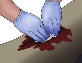 both hands. 1. Open the clothing over the bleeding wound 2. Wipe away any pooled blood 3. Pack (stuff) the wound with bleeding control gauze (preferred), plain gauze, or clean cloth. 12 4.