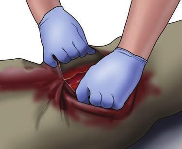 SECTION 4: B BLEEDING B Find the source of bleeding Open or