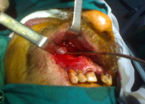 Maxillary Sinus Hydatid Cyst A Caldwell-Luc approach was adopted for excision of the cystic mass (Fig. 2). further confirmed the presence of hydatid disease. Fig 2: Caldwell-Luc procedure.