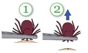 Removing Ticks Safely remove attached ticks with pointed tweezers and save ticks for future testing. Disinfect area. Consider prophylactic antibiotics.
