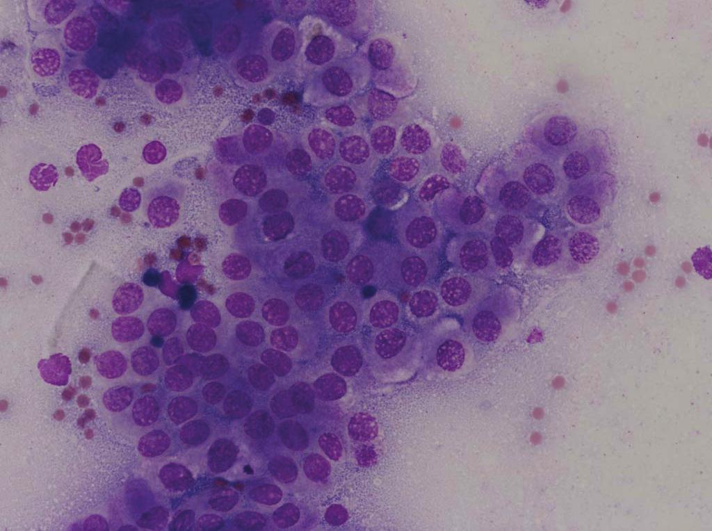 Note the positive apical staining. Figure 2: Initial cytology of nasal mass with large cluster of round to polygonal epithelial cells, Wright-Geimsa stain, 50x objective.