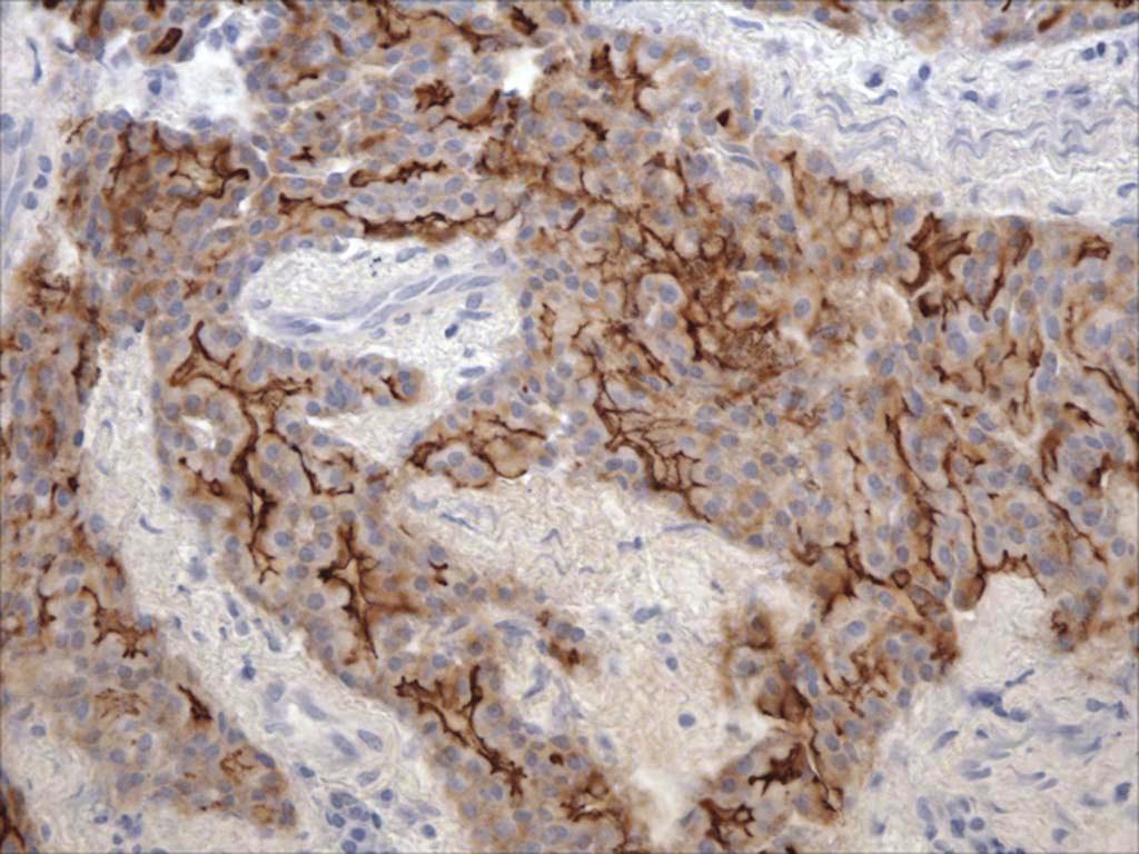 IHC was performed using a mouse monoclonal antibody against the Jaagsiekte sheep retrovirus (JSRV) envelope protein.