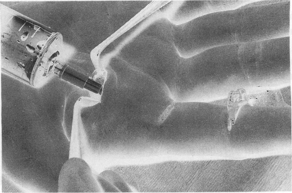 Fig. 1. Irrigation of an infetted flexor tendon sheath.