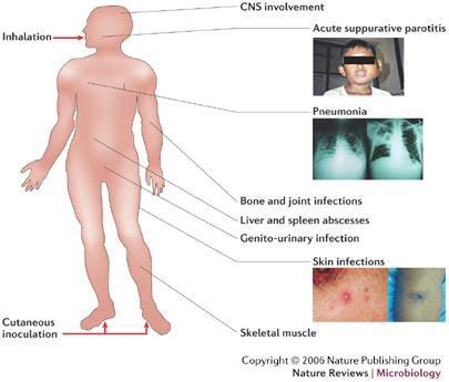 Melioidosis, a Disease with Many Faces Mortality rate 20-50% (depending on onset of treatment