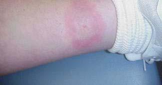 30 y/o woman presents with fever, headache, myalgias and a new rash on her left flank that had begun 7 days earlier Recently returned to Kentucky from opening her summer home on an island off the
