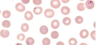 Babesia microti and divergens Incubation period: 1-4 weeks Malaria-like illness Obligate RBC intracellular parasite Mild to fatal Fulminant to fatal infection in asplenics Fever, chills,