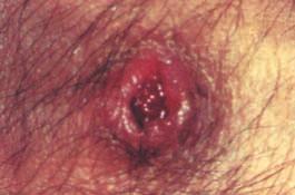 Under natural conditions, ulceroglandular tularaemia generally occurs about 3 days after intradermal inoculation (range 2-10 days) and manifests as regional lymphadenopathy, fever, chills, headache,