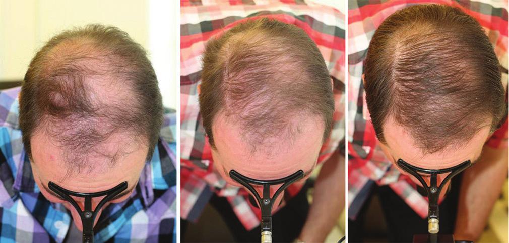 dding on low-level lser therpy (LLLT) to 4 yer pretretment with 5% topicl minoxidil solution () Before, nd () After 3 months of dded LLLT LLLT Low level lser therpy Tle 4: Comprtive ssessment of