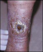 Recrudescent typhus or Brill-Zinsser disease is a recurrence of the disease after individuals were infected months or years previously.