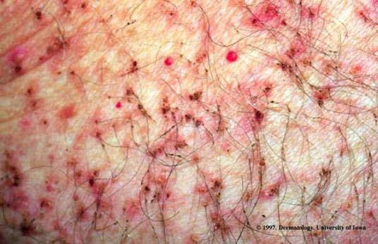 7.5.4 Pediculosis Infestation by lice is termed pediculosis; body lice - Pediculus corporis head lice - Pediculus capitis crab (pubic) lice Pediculus inguinalis Pediculus corporis Body lice were once