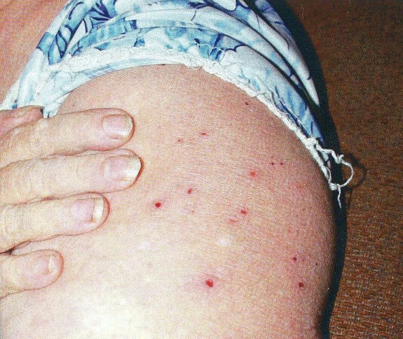 Bed bug bites on a woman s arm Richard Cooper, Cooper Pest Solutions 8.4 BEHAVIOUR Bed bugs are very resilient. Nymphs and adults can persist months without feeding.