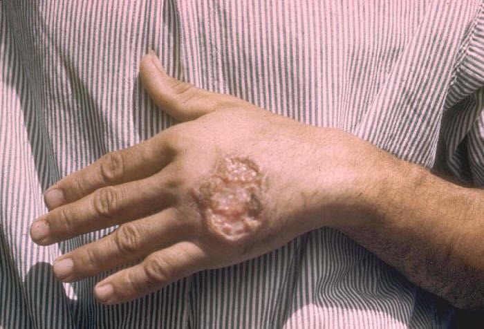 Leishmaniasis is found in parts of about 88 countries. Approximately 350 million people live in these areas.
