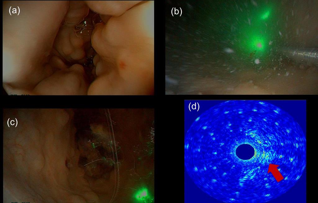 130 Optoacoustic imaging of esophageal tissue Fig. 7.9 Pictures of in vivo pig colon measurements. (a) Pig colon before water flushing; (b) and (c) Pig colon with flushing water.