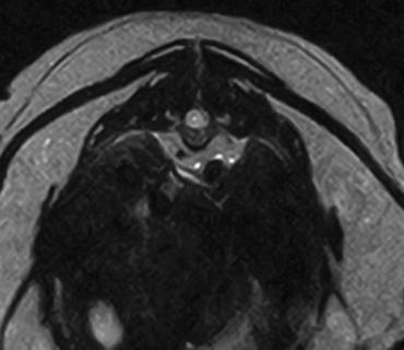 Meningomyelitis Caused by T. gondii 149 Fig 1. T2-weighted transverse magnetic resonance image: Hyperintense signal within the spinal cord in the white and gray matter.