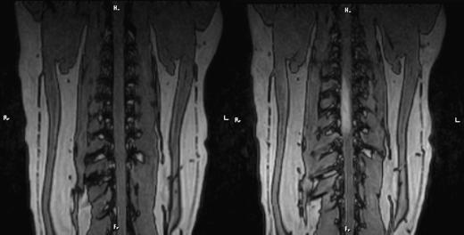 150 Alves et al Fig 3. T1-weighted dorsal section of the spinal cord pre- and postcontrast. Extension of the intramedullary lesion between T5 and T9 with strong contrast uptake.