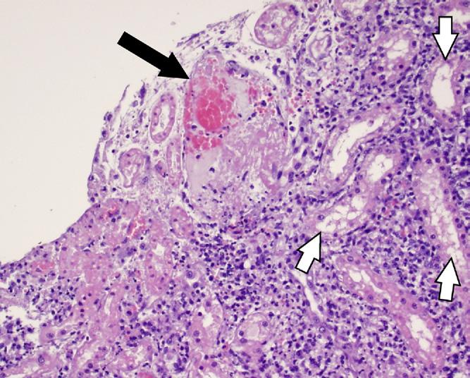 1152 Drechsler et al Fig. 10. Kidney. Superficial renal venules. Necrotic tubular epithelial cells (white arrows) with severe interstitial pyogranulomatous inflammation.