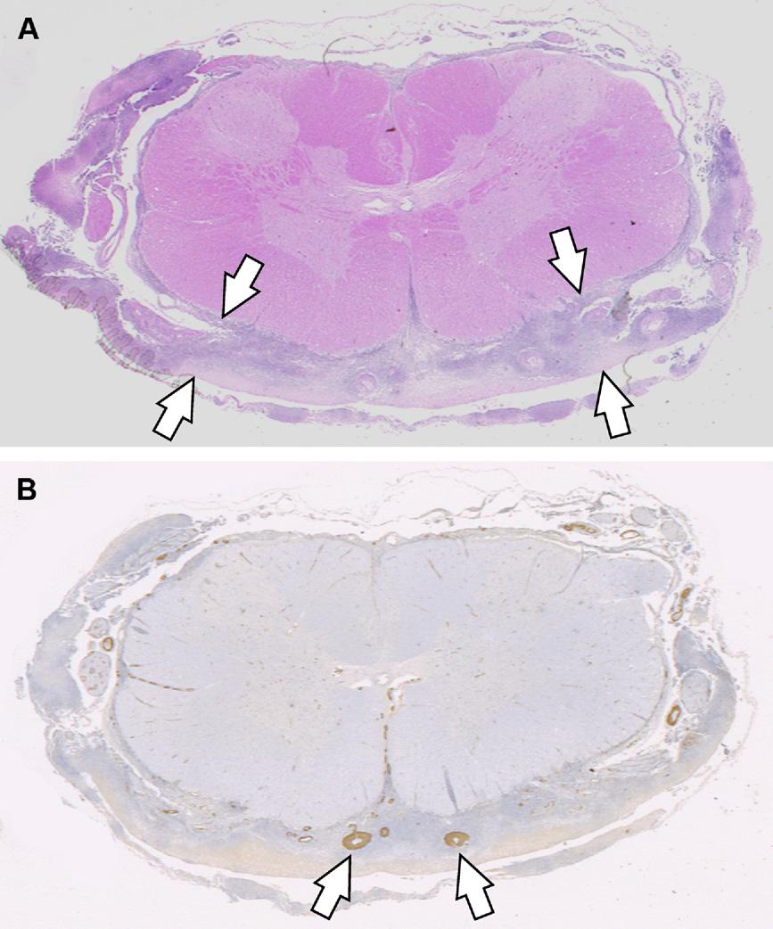 Feline Coronavirus in Multicat Environments 1153 Fig. 12. Spinal cord. (A) Subgross cross-section with marked thickening of the meninges due to pyogranulomatous inflammation (between white arrows).