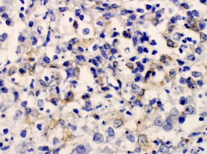 1154 Drechsler et al Fig. 13. Brain, lateral ventricle from a cat with FIP (FCoV immunohistochemistry stain).