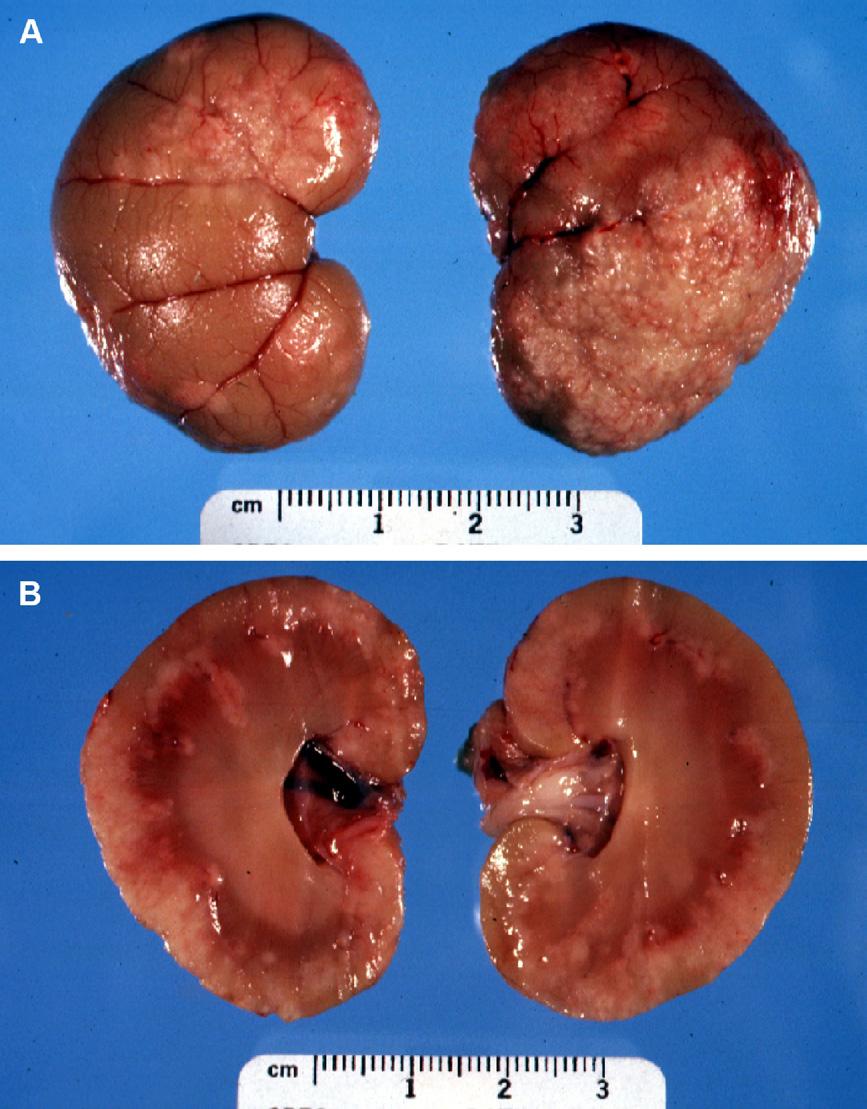 1140 Drechsler et al Fig. 4. Cat kidneys. (A) Multifocal to coalescing granulomatous inflammation (white, rough appearance) following the superficial blood vessels.