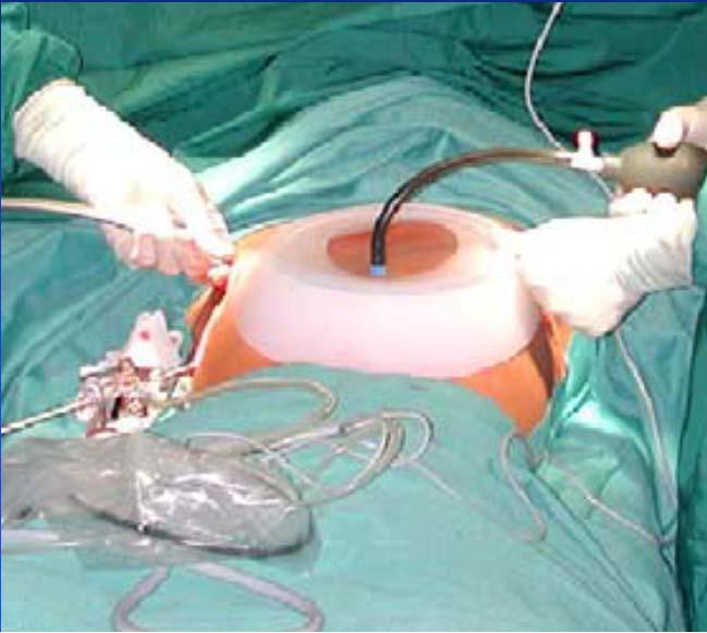 2. Vacuum Bell Technique: The Vacuum bell works well in young patients with a flexible chest. First used in 2005.
