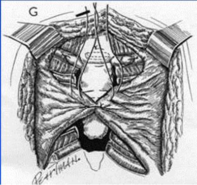 M.M. Ravitch in Pediatric Surgery, Fourth Edition, 1986 Complete resection of the costal cartilages on both sides, oblique transection