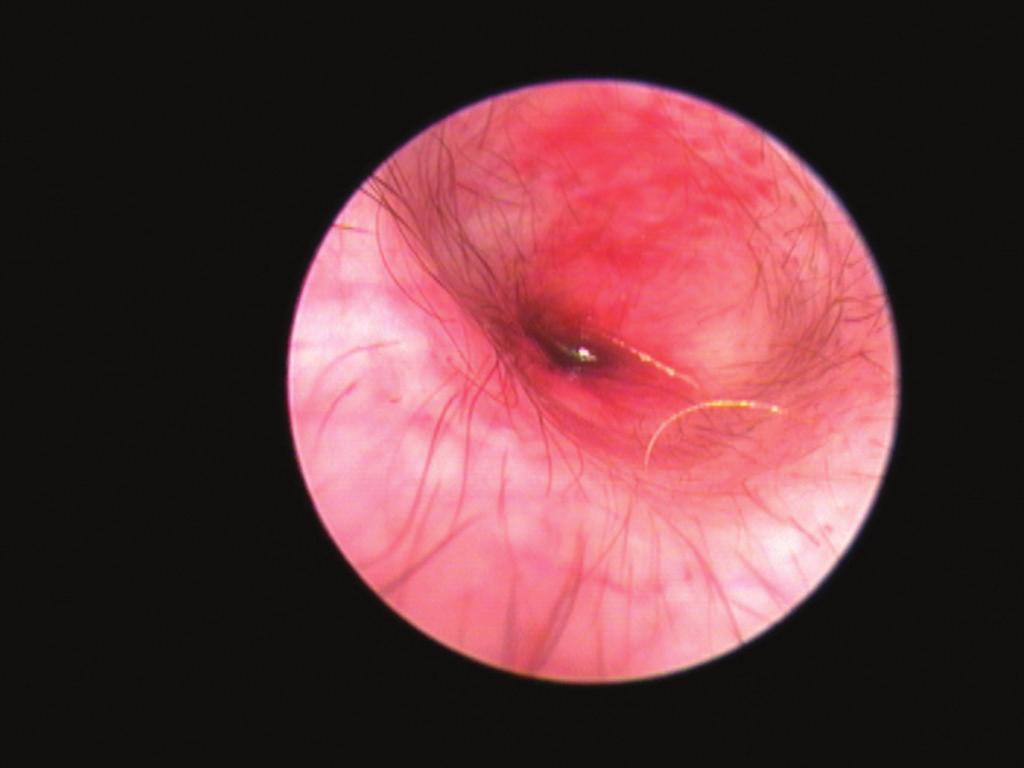 Fig 7: Narrowing of the external ear with early glandular hyperplasia is why surgical intervention, such as lateral wall resection, often fails to lead to prolonged periods of improvement in atopic